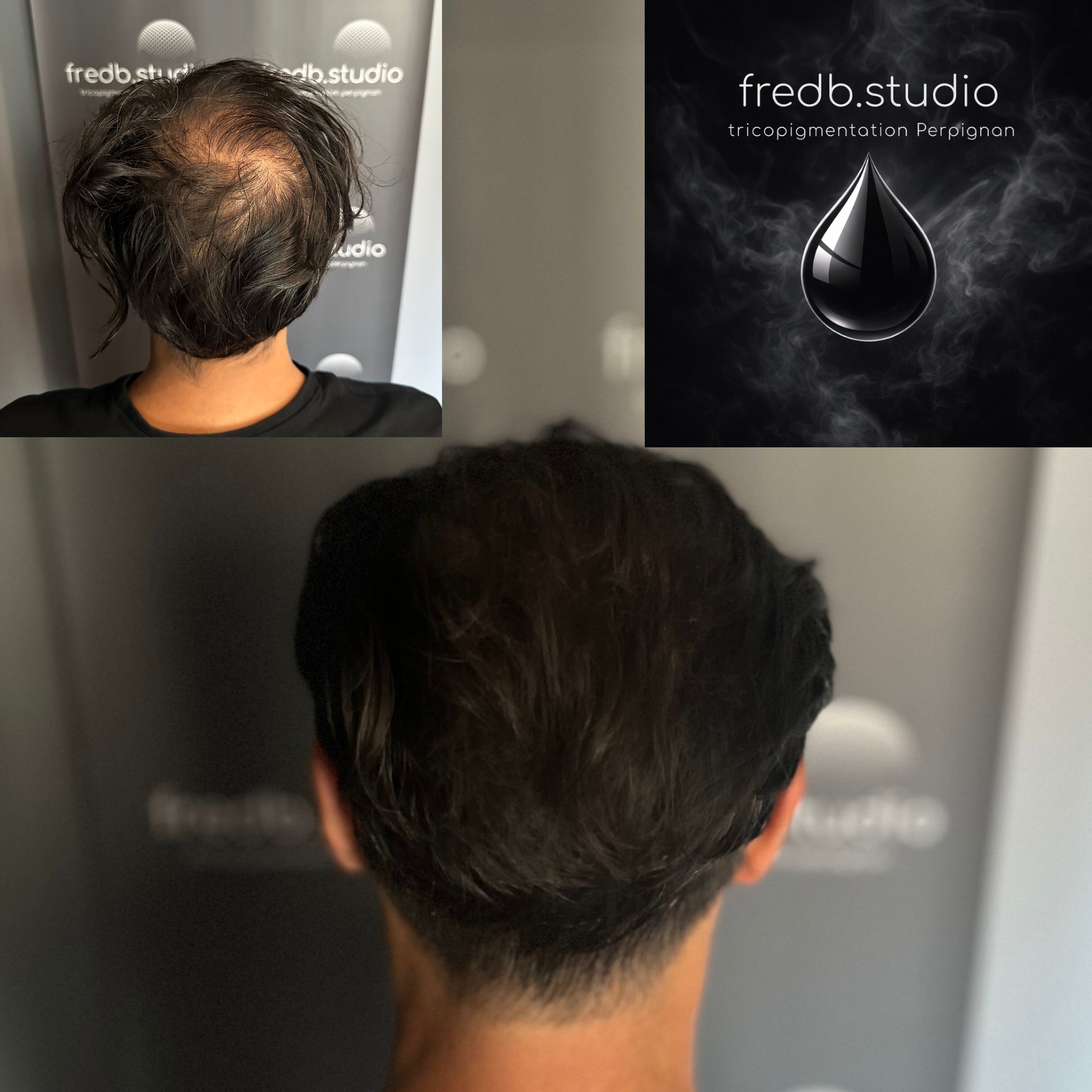 fredb.studio tricopigmentation Perpignan - Densification capillaire