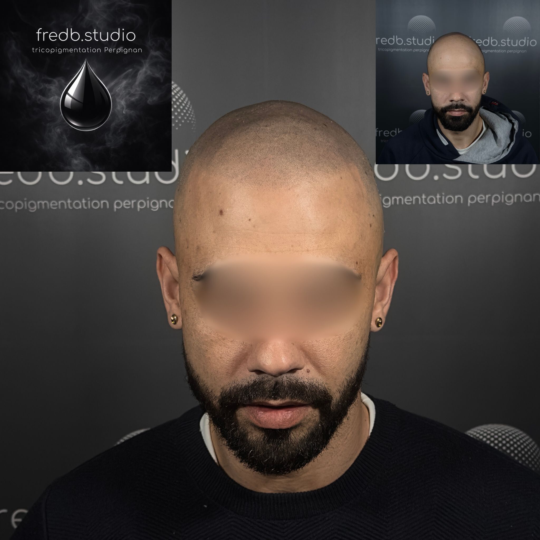 fredb.studio tricopigmentation Perpignan - Effet crâne rasé