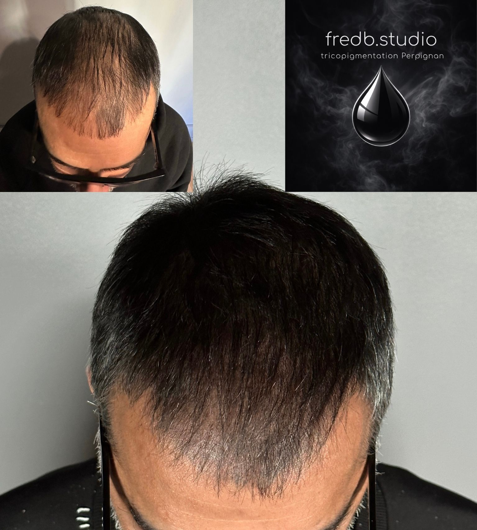 fredb.studio tricopigmentation Perpignan - Densification capillaire