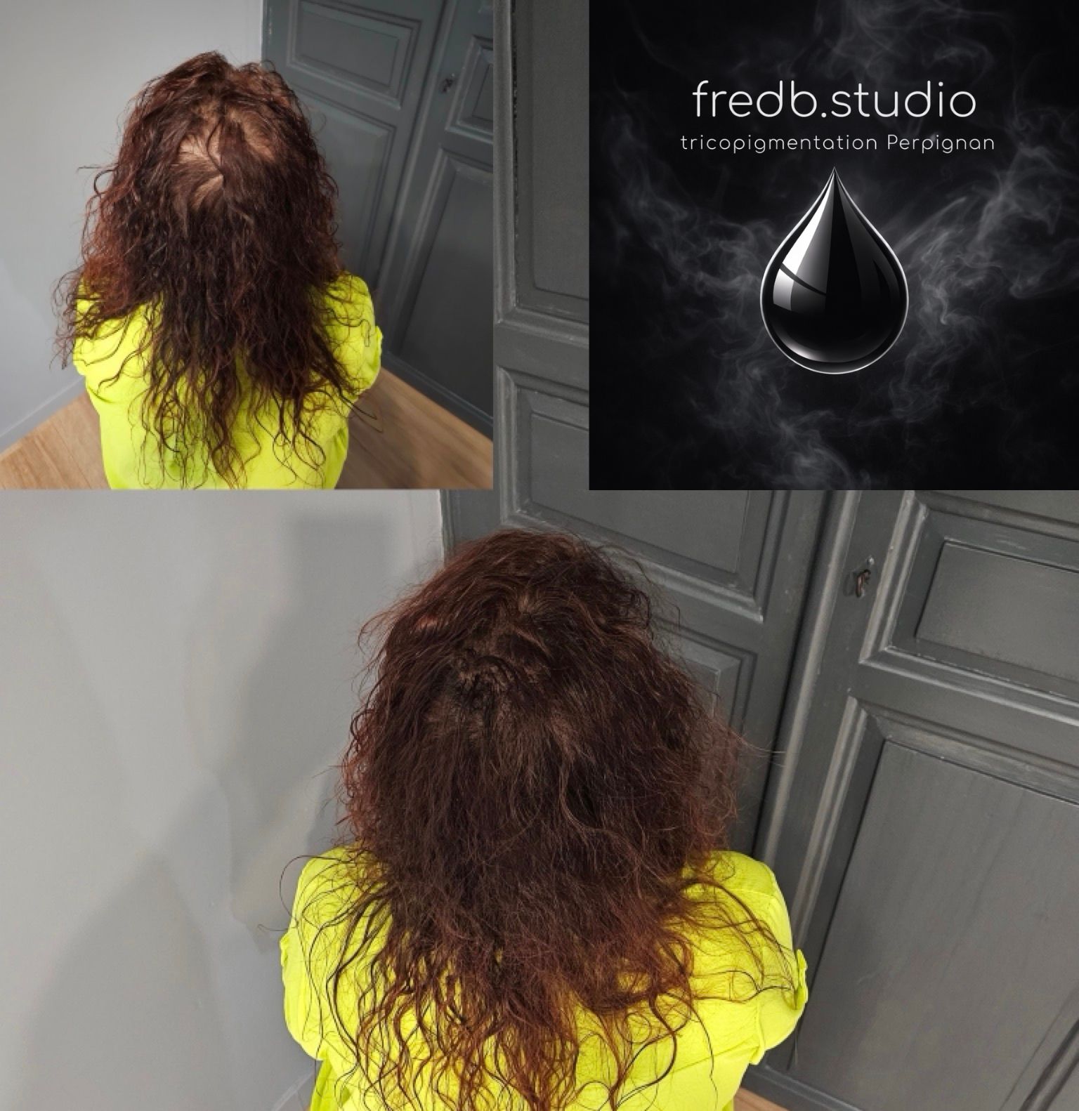 fredb.studio tricopigmentation Perpignan - Densification · pelade
