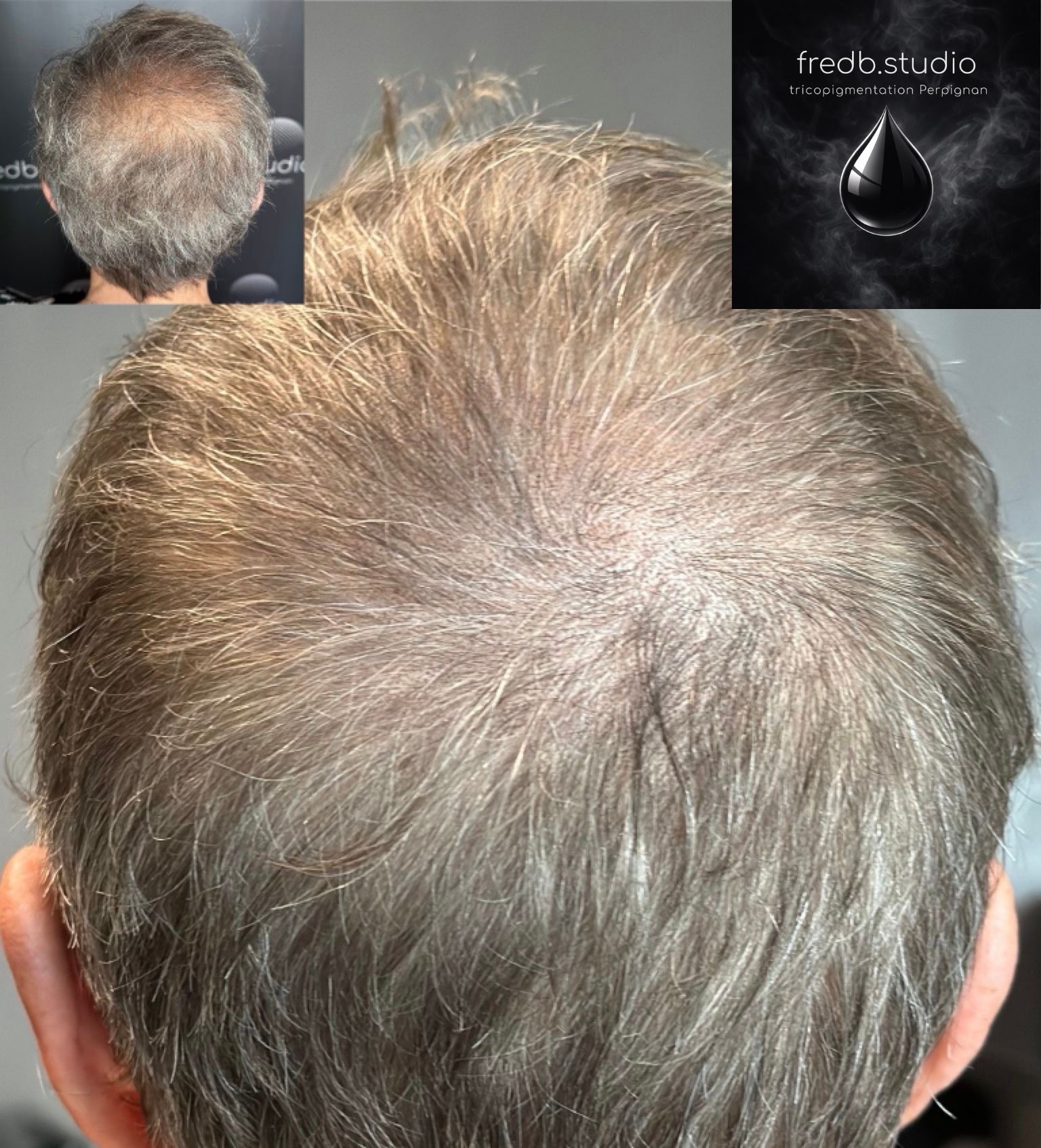 fredb.studio tricopigmentation Perpignan - Densification · suites de chimiothérapie