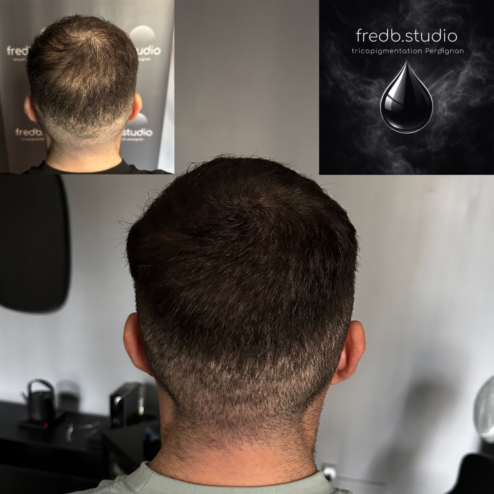fredb.studio tricopigmentation Perpignan - Camouflage cicatrices · densification après greffe