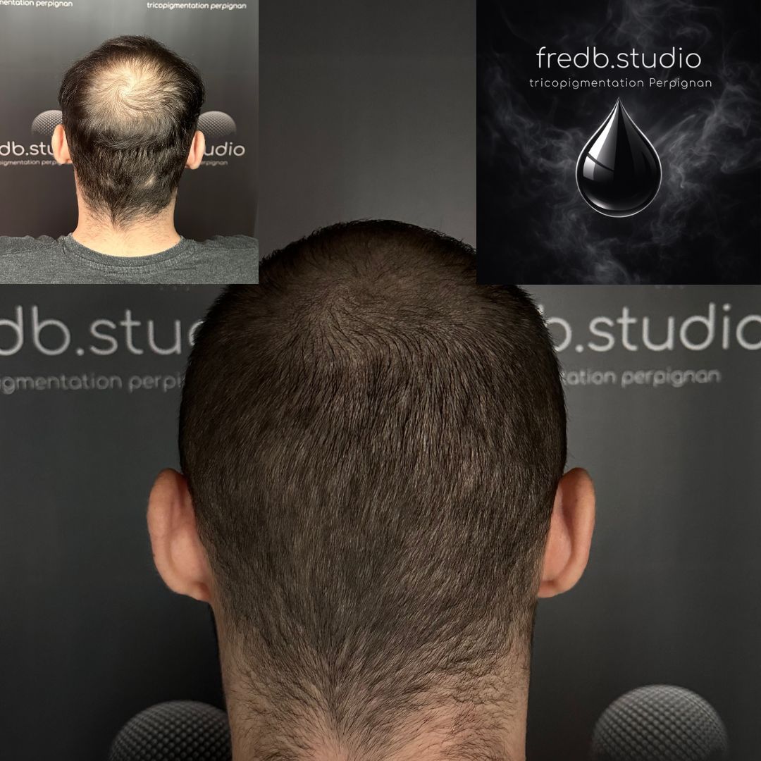 fredb.studio tricopigmentation Perpignan - Densification capillaire